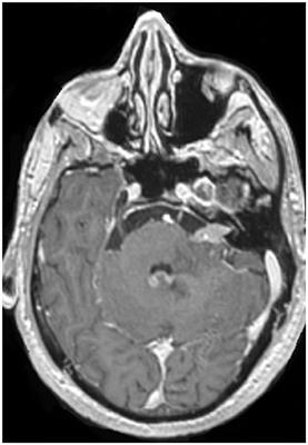 The Comparative Treatment of Intraventricular Chemotherapy by Ommaya Reservoir vs. Lumbar Puncture in Patients With Leptomeningeal Carcinomatosis